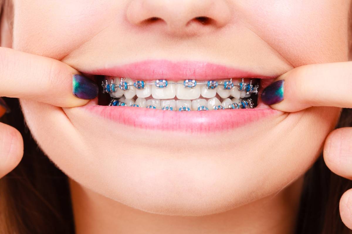 featured image for 6 long-term health benefits of braces