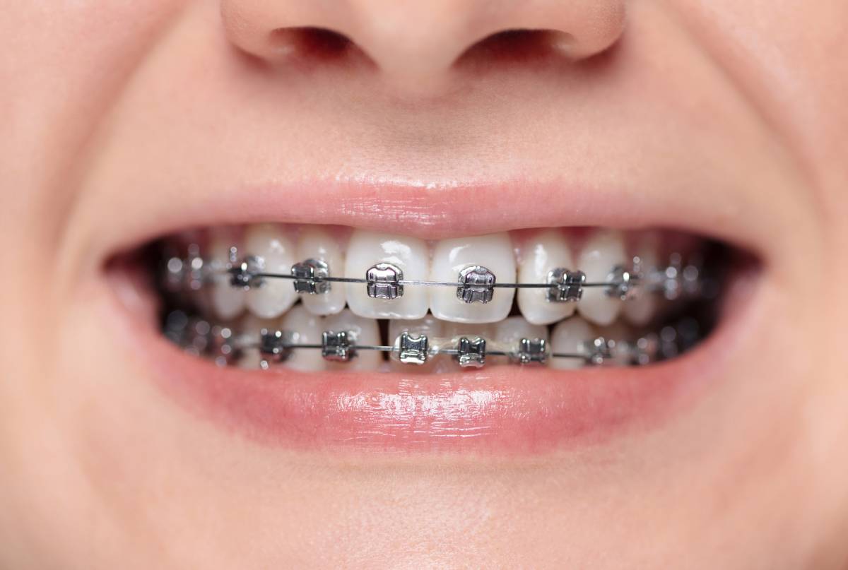 Woman with braces on her teeth is smiling.