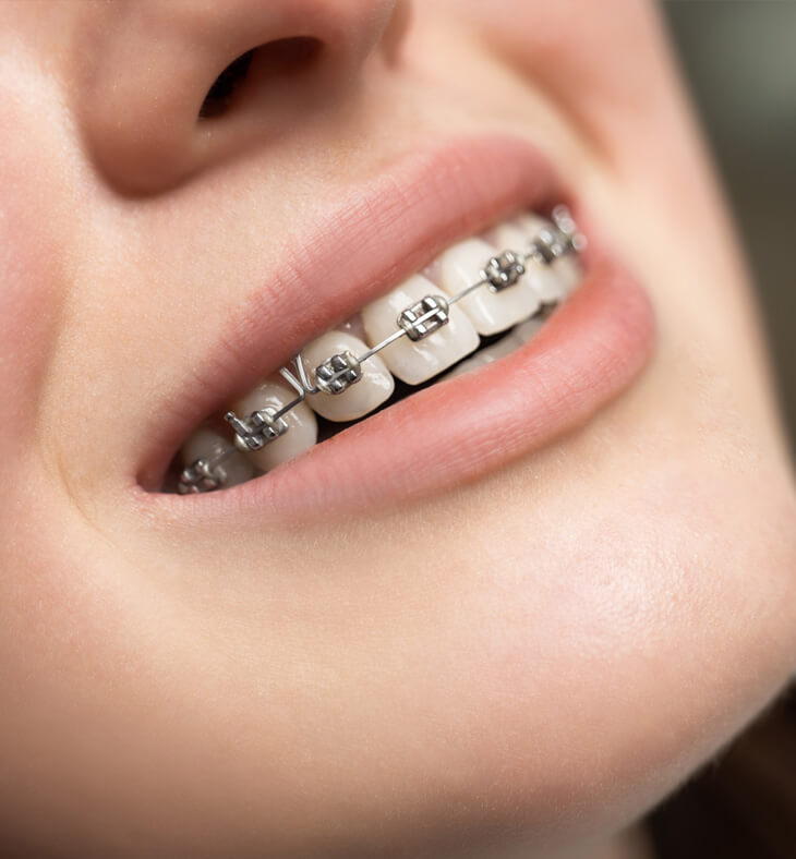 teeth with dental braces