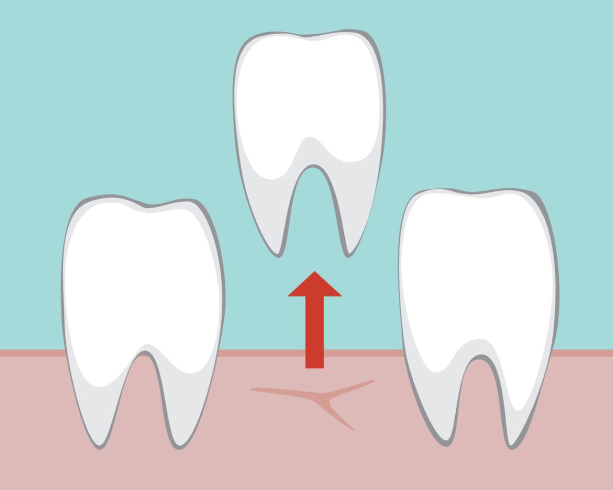featured image for article about first 24 hours after tooth extraction