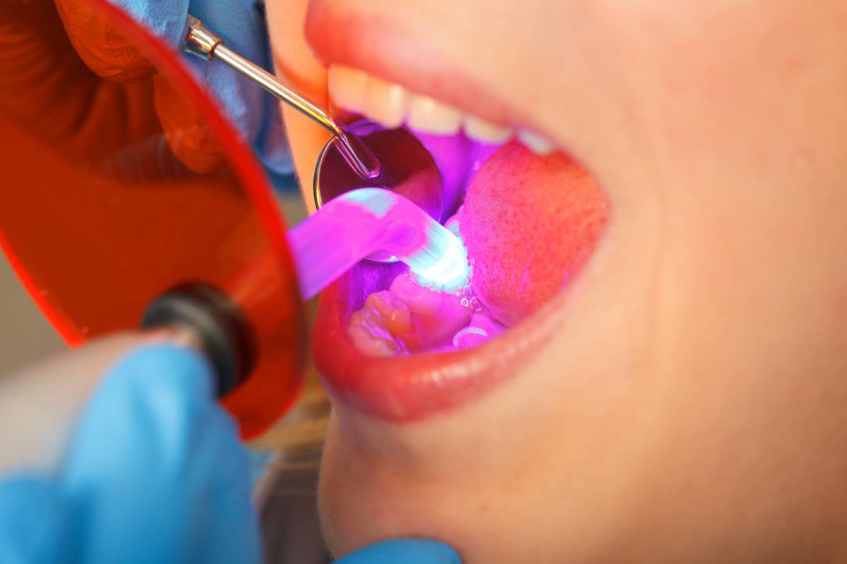 featured image for how long does dental bonding last