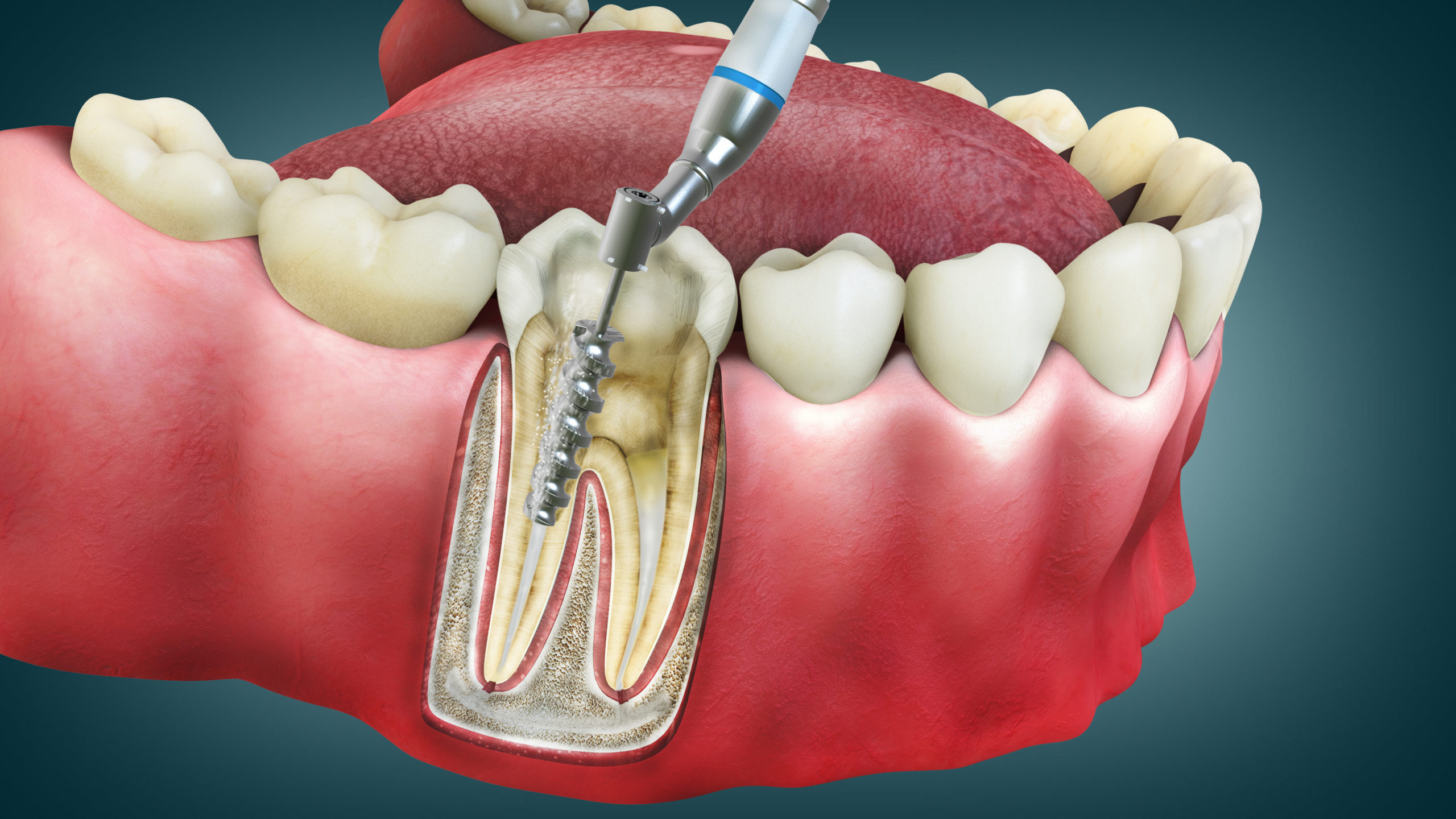 The image is of a 4D Root canal to show how to prepare for root canal procedure.