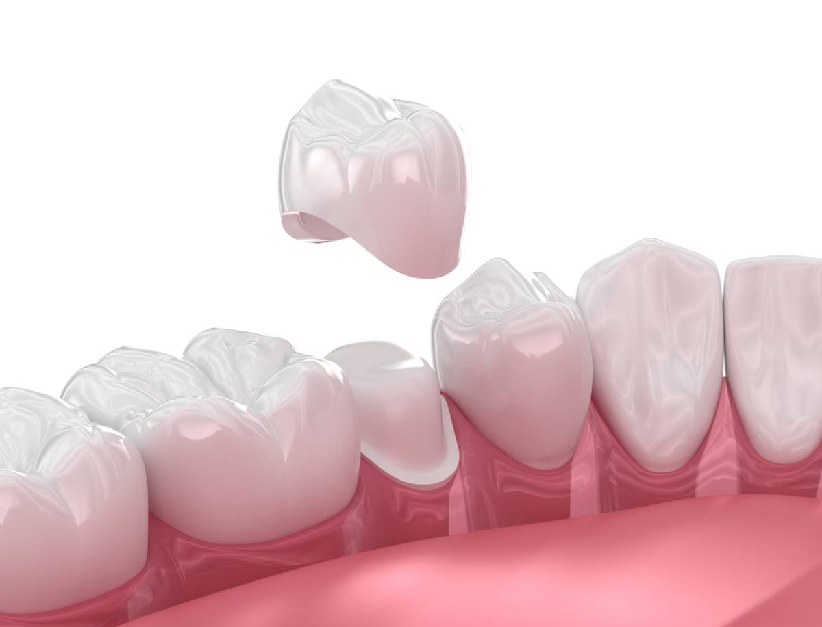 concept of should you replace old dental crowns