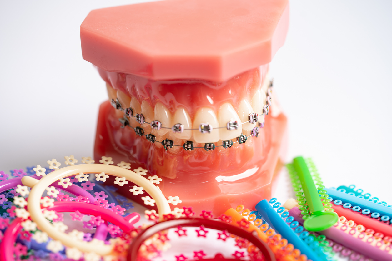 Featured image for Types of Braces